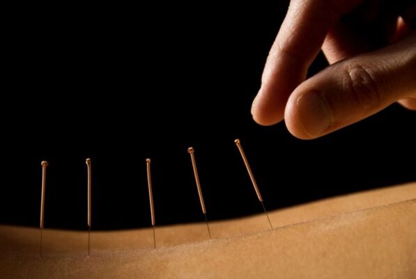 A acupuntura axudará a desfacerse da dor lumbar