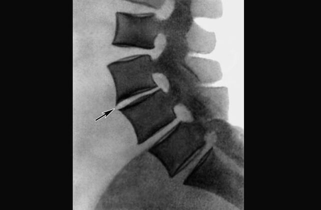 Manifestacións da osteocondrose da columna vertebral torácica nunha radiografía